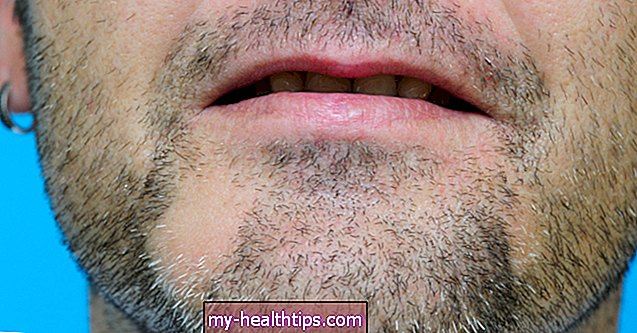 खालित्य बारबा: अपनी दाढ़ी पर बाल्ड स्पॉट्स का इलाज कैसे करें