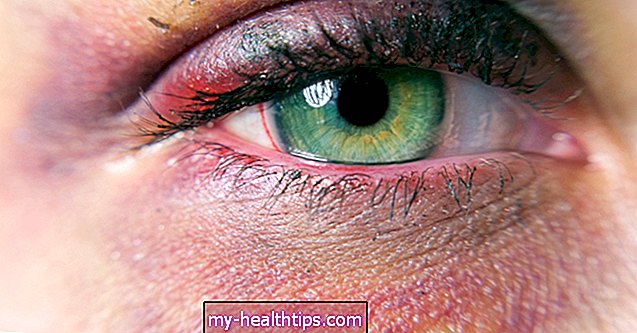 A legjobb otthoni gyógymódok a fekete szem számára