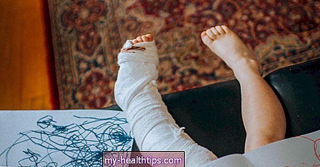 Brudt ben: symptomer, behandling og restitutionstid