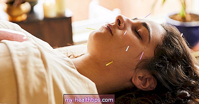 Az akupunktúra enyhítheti az IBS tüneteit?