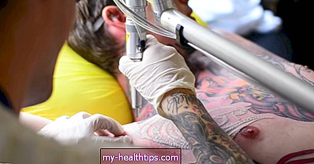 Всичко, което трябва да знаете за премахването на татуировки