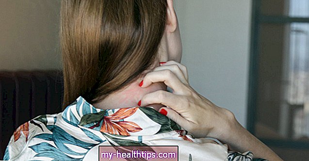 Kako hepatitis C može utjecati na vašu kožu