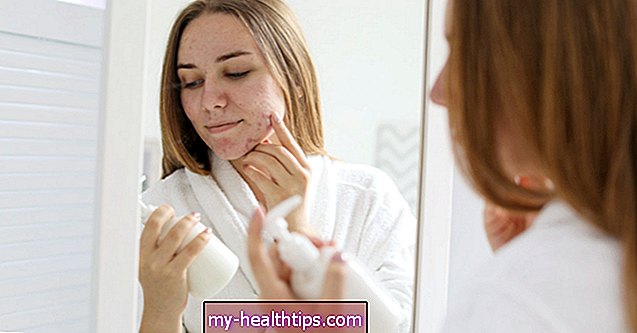 Hvordan man bedst behandler acne, når du har tør hud