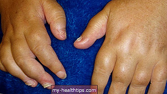 Psoriazinio artrito simptomai