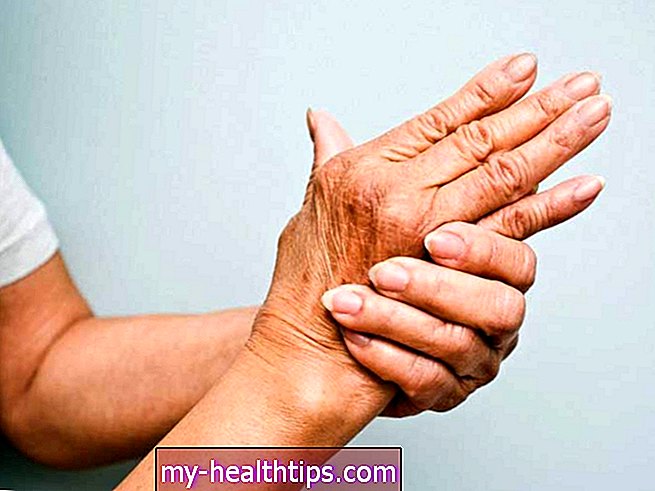 Todo lo que debes saber acerca de la artritis psoriásica