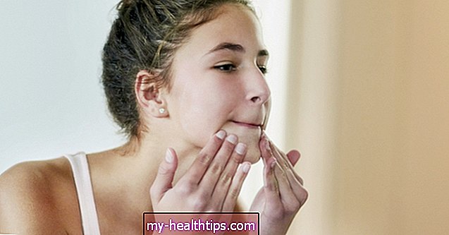 Hvordan acne vulgaris ser ud, og hvordan man behandler det