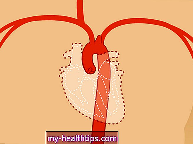Mažėjanti aorta (krūtinės ląstos)
